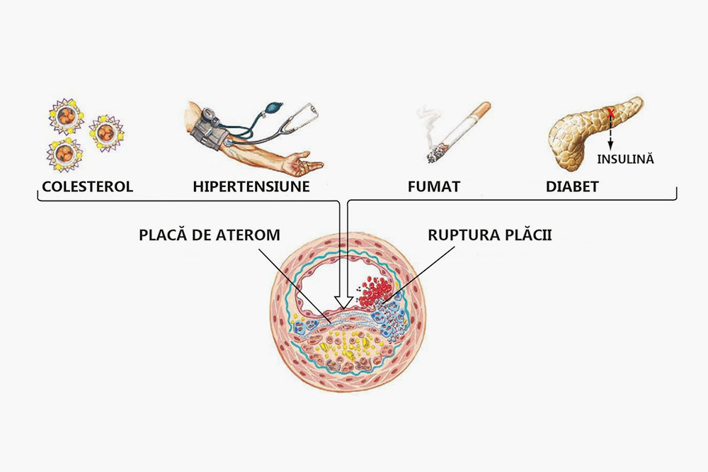 ateroscleroza vene